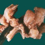 болезнь Менетрие