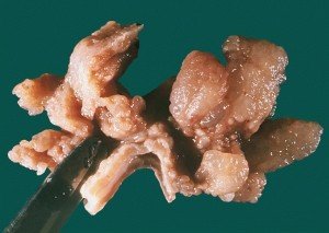 болезнь Менетрие