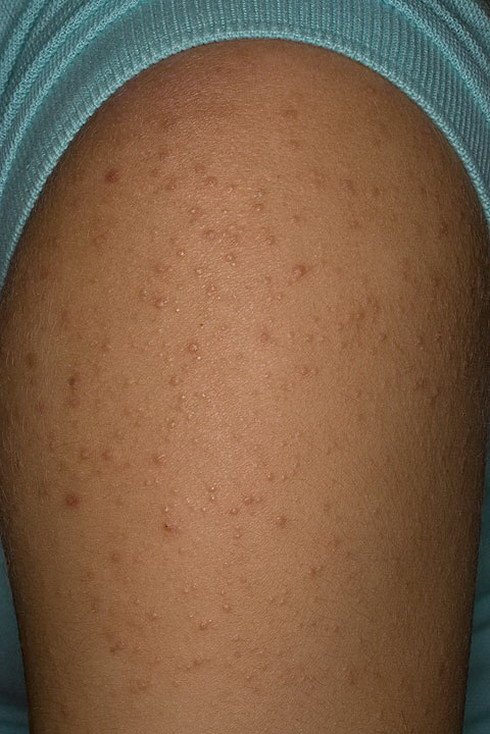 кератоз себорейный