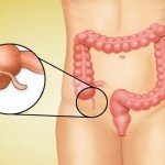 аппендицит у женщин