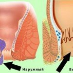 геморрой у женщин симптомы и лечение