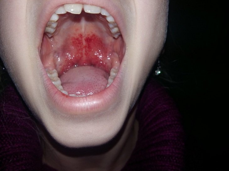 симптомы кори у детей