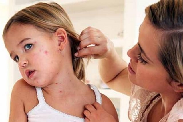 корь симптомы у детей фото