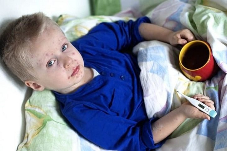 признаки кори у ребенка