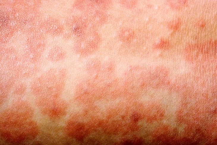 корь фото сыпи