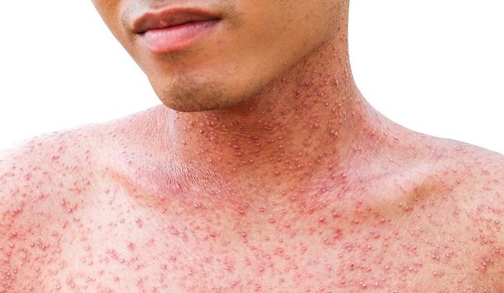 корь симптомы у взрослых