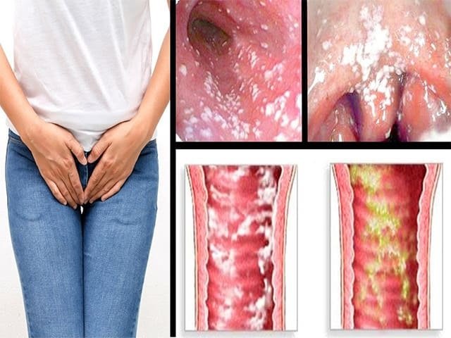 молочница у женщин как выглядит