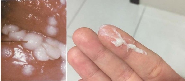 кандидоз у женщин