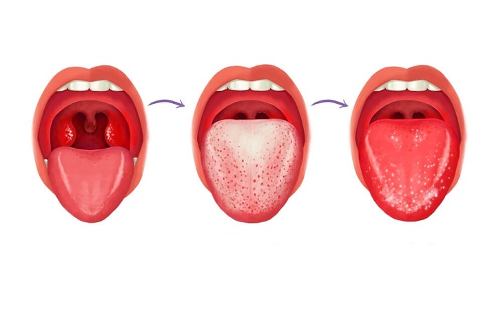 скарлатина у детей